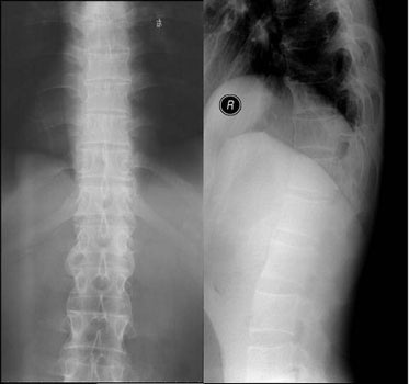 蔡志的CT检查显示，脊柱弯曲，关节间隙变窄
