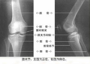 急性滑膜炎的危害有哪些