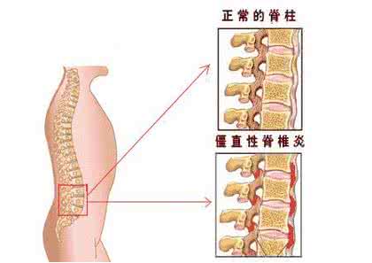 强直性脊柱炎跟肠道感染有关吗