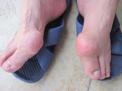 脚部痛风石会有什么症状表现?