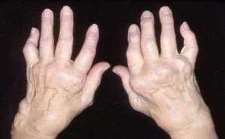 手指类风湿性关节炎有哪些症状?郑州痛风风湿病医院介绍
