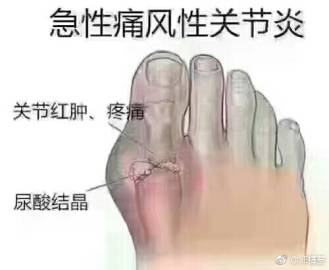 痛风十几二十年还有 的可能吗?