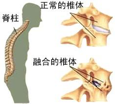 得强直性脊柱炎的原因是什么?几率是多少?