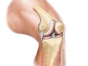 膝关节急性滑膜炎要怎么办?有什么好的方法吗?