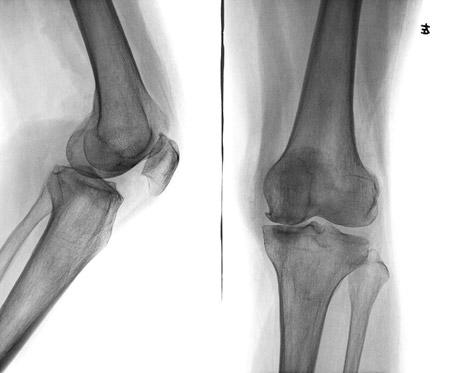 膝关节滑膜炎会有哪些危害表现?会致残吗?