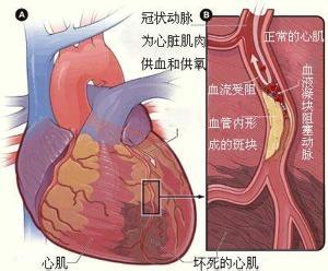 风湿热会不会的肾脏有损害?怎么能诊断是不是风湿热?