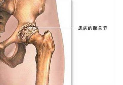 类风湿性关节炎会引发骨头坏死吗?