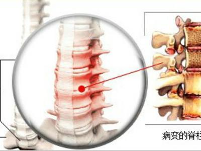 强直性脊柱炎是风湿病的一种?要怎么护理?