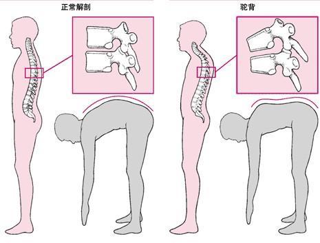 强直性脊柱炎常见的并发症有哪些?