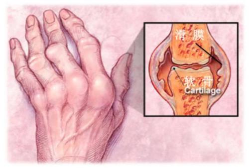 类风湿性关节炎2个比较有效的护理方法
