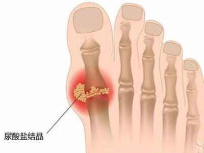 日常生活中，肥胖人群是不是更易患上痛风疾病？