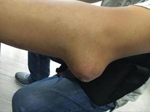 工作的忙碌、饮食的不规律使他步入痛风晚期,王怀庆专家为其排解烦恼! 工作的忙碌、饮食的不规律使他步入痛风晚期,王怀庆专家为其排解烦恼!