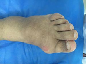工作的忙碌、饮食的不规律使他步入痛风晚期,王怀庆专家为其排解烦恼! 工作的忙碌、饮食的不规律使他步入痛风晚期,王怀庆专家为其排解烦恼!