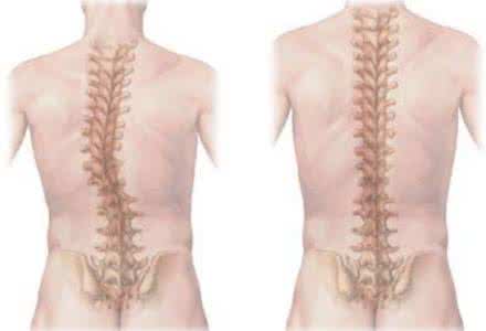 治疗强直性脊柱炎的过程就是一个长期作战的过程！