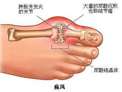 总是被痛风折磨？想摆脱它还愁找不到方法？！
