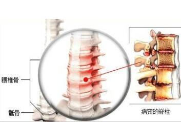 强直性脊柱炎分期看这些症状表现，是不是能了解的更清楚？