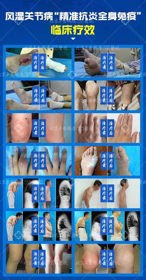 8·19首届中国医师节|郑州专家大型公益会诊 暨风湿关节病“精准抗炎全身免疫”临床疗效成果展示月 8·19首届中国医师节|郑州专家大型公益会诊 暨风湿关节病“精准抗炎全身免疫”临床疗效成果展示月