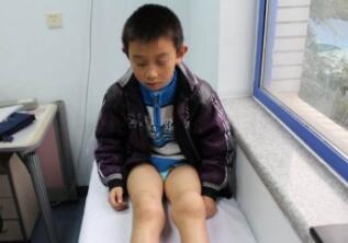 小儿髋关节滑膜炎，髋关节暂时性滑膜炎会引起后遗症吗?