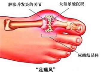 脚痛风最有用的医治办法!