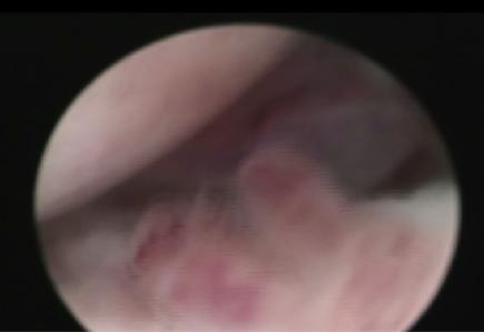 中医微创可视针刀镜技术的操作过程 郑州痛风风湿病医院中医微创可视针刀镜技术