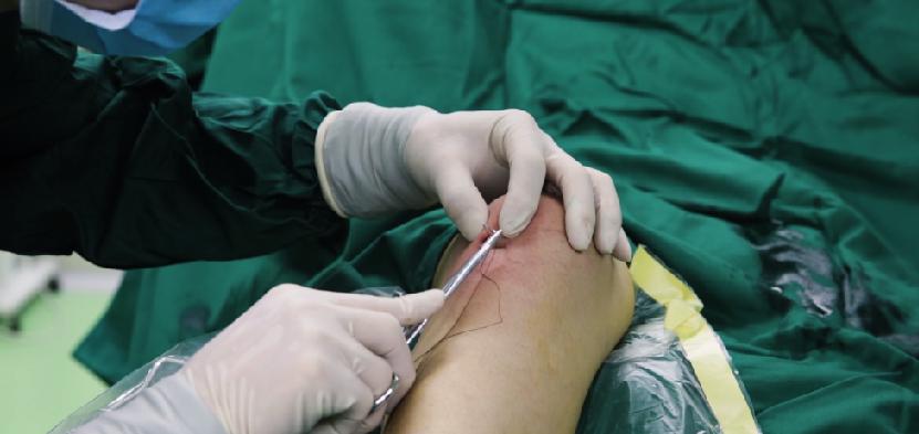 郑州痛风风湿病医院中医微创可视针刀镜技术