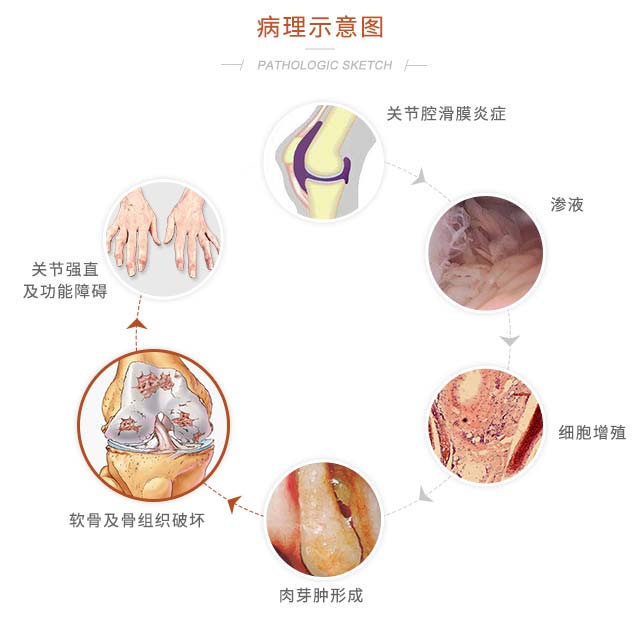 关节PRP技术