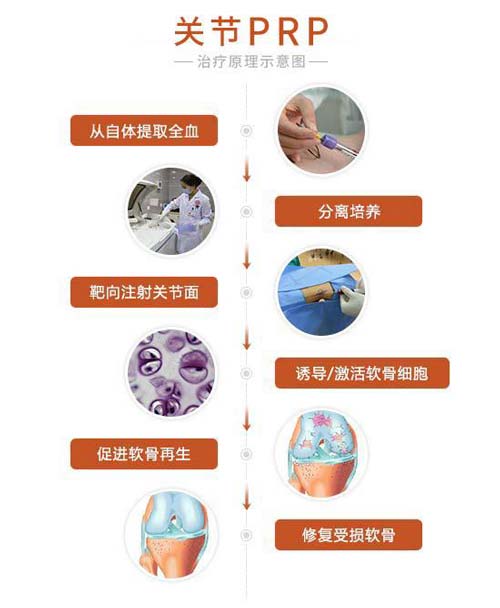 关节PRP技术 关节PRP技术