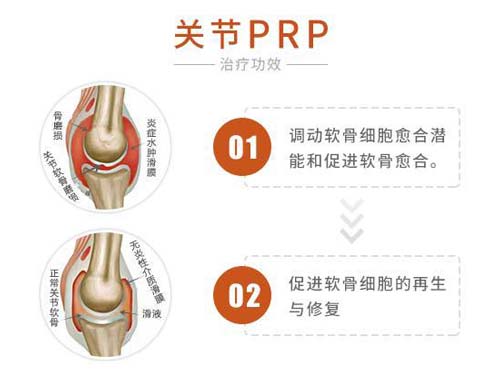 关节PRP技术治疗功效 关节PRP技术