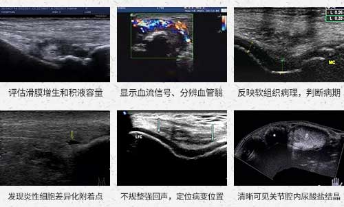 肌骨超声技术临床应用 欧美新一代MSUS肌骨超声技术临床应用