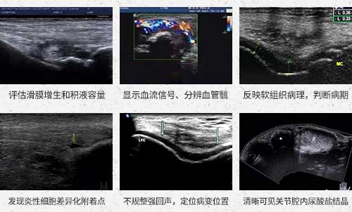 欧美新一代MSUS肌骨超声技术临床应用