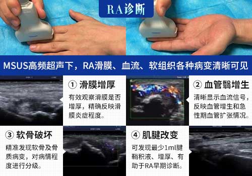 肌骨超声技术临床应用 欧美新一代MSUS肌骨超声技术临床应用