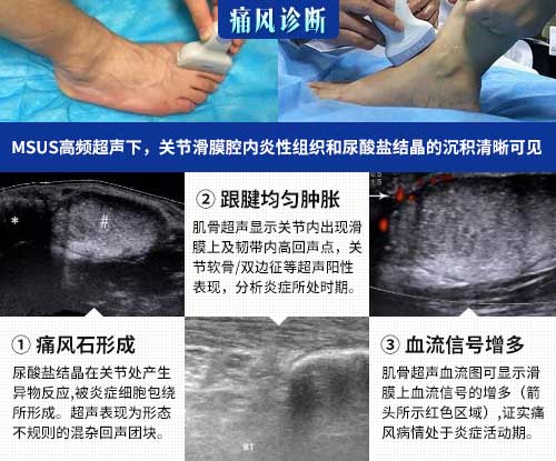肌骨超声技术临床应用 欧美新一代MSUS肌骨超声技术临床应用