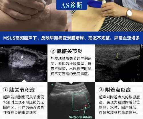 肌骨超声技术临床应用 欧美新一代MSUS肌骨超声技术临床应用