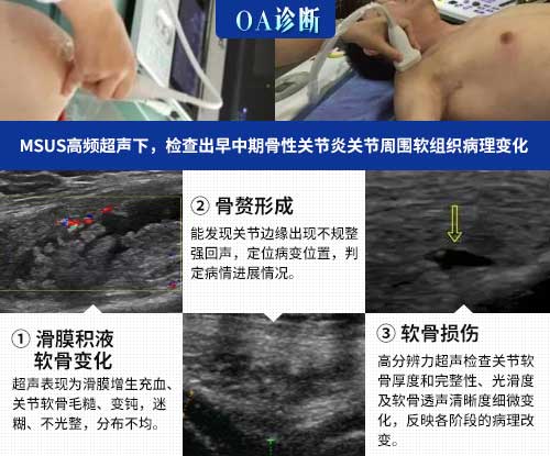 肌骨超声技术临床应用 欧美新一代MSUS肌骨超声技术临床应用