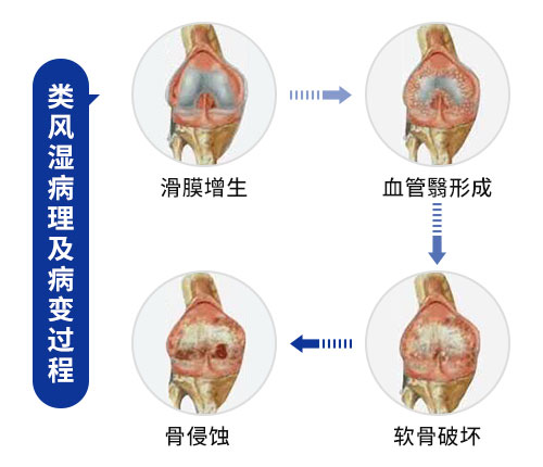 肌骨超声在类风湿性关节炎上临床应用：