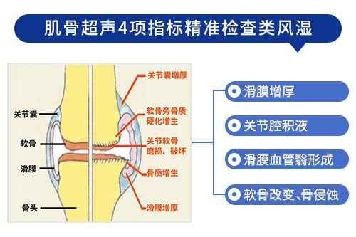 肌骨超声在类风湿性关节炎上临床应用：