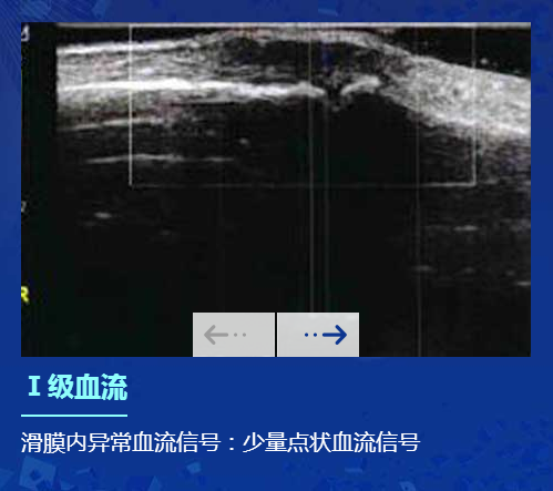 肌骨超声在类风湿性关节炎上临床应用：