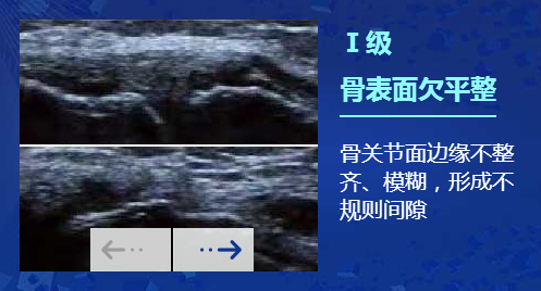 肌骨超声在类风湿性关节炎上临床应用：