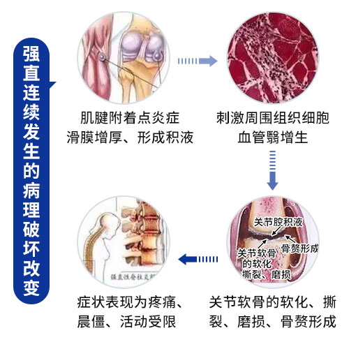 肌骨超声在强直性脊柱炎上临床应用