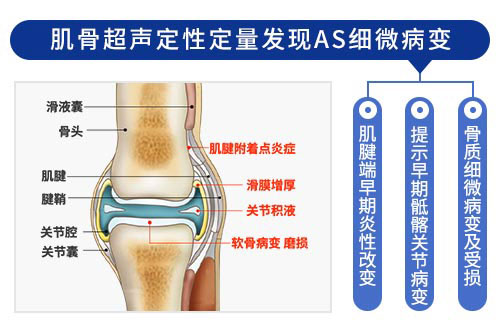 肌骨超声在强直性脊柱炎上临床应用