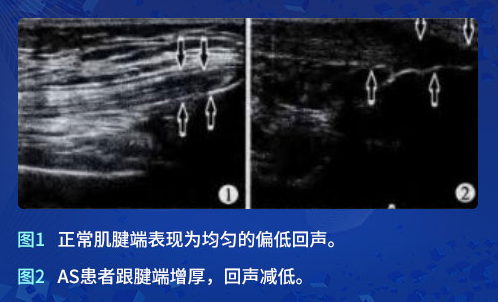 肌骨超声在强直性脊柱炎上临床应用