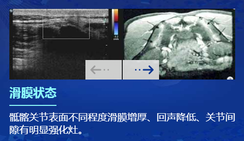 肌骨超声在强直性脊柱炎上临床应用