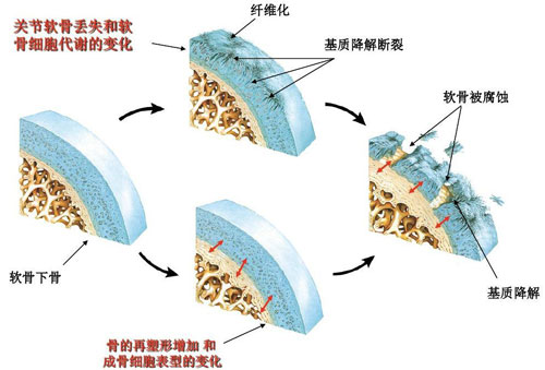 肌骨超声技术在骨关节炎上临床应用