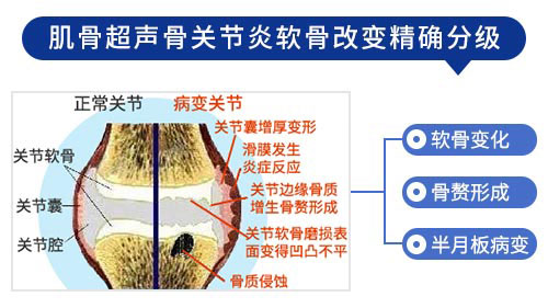 肌骨超声技术在骨关节炎上临床应用