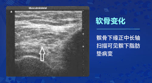 肌骨超声技术在骨关节炎上临床应用