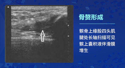 肌骨超声技术在骨关节炎上临床应用