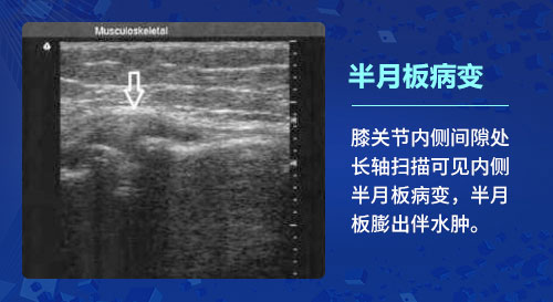 肌骨超声技术在骨关节炎上临床应用