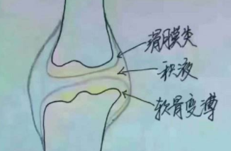 不同年龄人群患滑膜炎的原因是什么