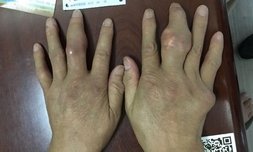 治疗前,胡先生双手关节多处形成大小不一痛风石 痛风17年“石头”遍全身 规范化治疗助其
