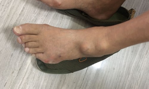 胡先生左脚脚踝处出现痛风石 痛风17年“石头”遍全身 规范化治疗助其